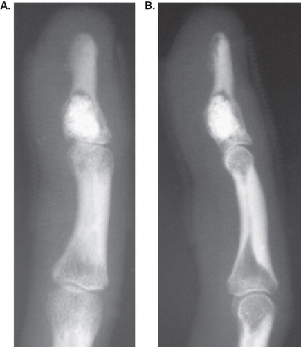 Figure 3.  Post-surgery, anteroposterior (A) and lateral (B) radiograms of the little finger show artificial bone completely filling the cavity in the distal phalanx previously occupied by the tumor.