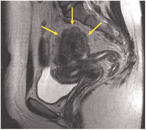 Figure 1. Sagittal T2-weighted MR-image of the pelvis. The solid lesion invading the recto-sigmoid colon is indicated with yellow arrows.