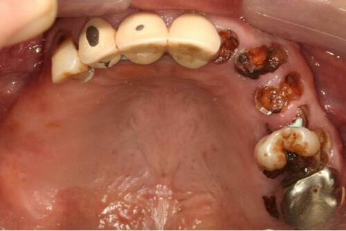 Figure 3 Upper occlusal view (flipped mirror image).