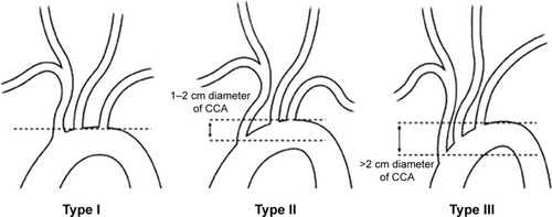 Figure 1 Illustration of the three types of the aortic arch. The upper line indicates the level of the top of the aortic arch, and the dotted line indicates the level of the origin of the brachiocephalic branch.