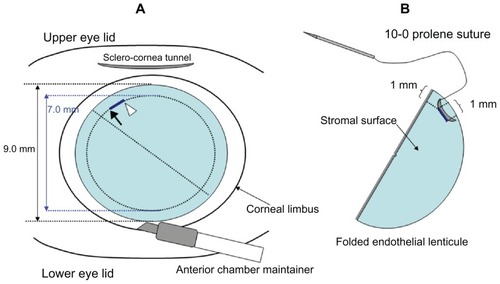 Figure 1 Schematic diagram for the use of a 10-0 prolene suture in Descemet-stripping automated endothelial keratoplasty. (A) Markings of 7.0 mm in diameter, and points where the needle will be passed. The black arrow and white arrowhead show the points through which the straight needle and curved needle will be passed, respectively. (B) A folded endothelial lenticule and markings through which the curved needle will be passed.
