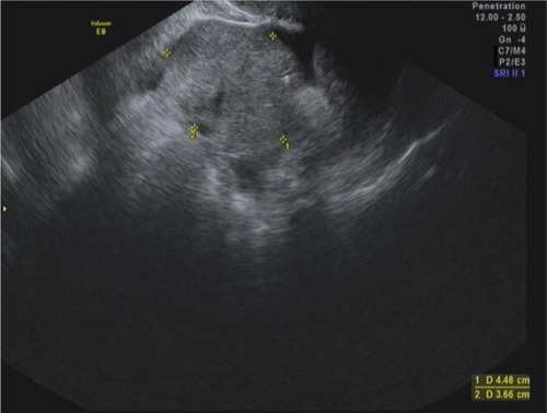 Figure 10 Transvaginal ultrasound scan of a 59-year-old woman.