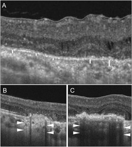 Figure 6. Optical coherence tomography (OCT) scans of different patients with posterior uveitis. The OCT line scan in panel A shows a patient with multifocal choroiditis with an irregular choriocapillaris slab demonstrated by white parallel lines. The OCT scans in panels B and C show two patients with differences in the reflectivity of the retinal pigment epithelium (RPE) and the outer retina. The scan (B) shows relative atrophy and thinning of the RPE and consequent hyper-reflective signal transmission masking the choriocapillaris layer (white arrowheads). The scan (C) shows hyper-reflectivity of the RPE and the outer retina resulting in back shadowing and poor visibility of the choriocapillaris layer (white arrowheads).