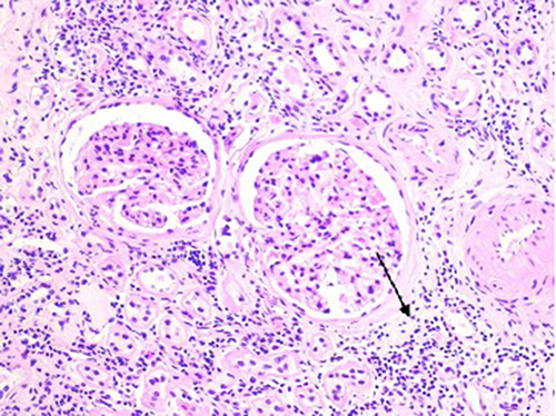 Figure 2 Histopathology of renal puncture in the test group showed that the renal interstitium is obviously edematous with much cell infiltration, mainly monocytes and lymphocytes (black arrow, x200).