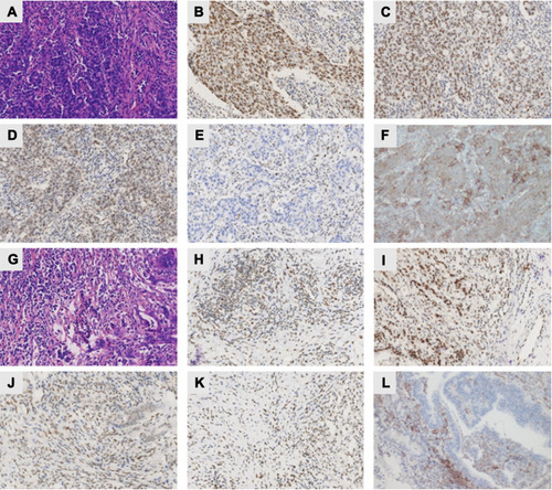 Figure 1 Heterogeneous morphology, MMR protein expression and PD-L1 expression patterns of the 2 synchronous rectal tumours (masses A and B) in the LS patient. (A and G) HE staining of masses A and B showing the classic protruding pattern of adenocarcinoma growth. The IHC staining of mass A showed intact expression of MLH1 (B), PMS2 (C), MSH2 (D), and PD-L1 (F) in addition to loss of expression of MSH6 (E). Mass #B showed intact expression of MLH1 (H), PMS2 (I), MSH2 (J), MSH6 (K) and PD-L1 (L). All images were collected at 100× magnification.