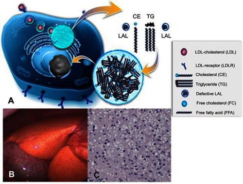 Figure 2 Summary of the mechanisms of disease. Cholesterol is physiologically taken up as cholesteryl esters via the LDL receptor – endocytosis pathway into lysosomes and then hydrolyzed by LAL enzyme (A). In cases of defective LAL activity cholesteryl esters and triglycerides accumulate in lysosomes, leading to universal microvesicular hepatic steatosis with development of fibrosis (C). Cholesterol accumulation causes orange coloration of the fatty liver (B), which is different from the triglyceride accumulation characteristic of common-type non-alcoholic fatty liver disease. (A) Published with permission of Alexion Pharmaceuticals. (B) and (C) Reproduced from Zandanell S, Primavesi F, Aigner E. Hepatosteatosis from Lysosomal Acid Lipase Deficiency. J Gastrointest Surg. 2019;23(3):601-602 (http://creativecommons.org/licenses/by/4.0/).Citation44Abbreviations: LAL, lysosomal acid lipase; CE, cholesteryl ester; TG, triglyceride; LAL, lysosomal acid lipase; LDL, low-density lipoprotein.