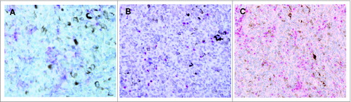 Figure 2. Lymphocytes infiltrating uveal melanomas express CD8, FOXP3 and CCL5. (A–C.) Immunohistochemical (IHC) analysis of formalin-fixed paraffin embedded uveal melanoma patient samples for the expression of the indicated marker. Antibody staining was detected using ChromoMap Fast Red chromogenic substrate. Representative results are shown. (A) Example of IHC staining using anti-CD8 antibody at 40 magnification and exhibiting membranous staining. (B) Example of IHC staining using anti-FOXP3 antibody at 40× magnification and exhibiting nuclear staining. (C) Example of IHC using anti-CCL5 antibody at 20 magnification. The red chromogen highlights the cytoplasm of CCL5-positive lymphocytes, which are seen infiltrating the CCL5-negative melanoma cells.