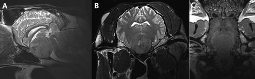 Figure 1. (A) T2w sagittal, (B) T2w transverse and (C) T1w 3D reconstructable magnetization-prepared gradient-echo (MP-RAGE) with contrast medium (gadoteric acid, clariscan TM, GE Healthcare AG, opfikon, Switzerland) dorsal magnetic resonance images of the head of a 16-year-old warmblood mare, depicting a large well-delineated pituitary macroadenoma compressing the thalamus, the midbrain, and the optic chiasm.