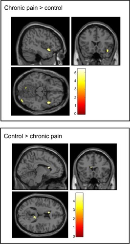 Figure 2 Brain regions showing enhanced neuronal responses to innocuous somatic pressure stimulation between the chronic pain group and the control group.