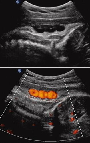 Figure 2 Upper panel: Sagittal image of vertex-presenting fetus. The “divot sign”. Note three separate “divots” in the subcutaneous tissue of the posterior aspect of the fetal neck, representing and associated with a triple nuchal cord at delivery. Lower panel: Power Doppler image depicting the above triple nuchal cord.