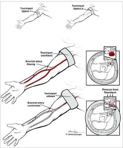 Figure 4. Tourniquet application. (A) The tourniquet may be placed at mid-humeral (for elbow transection) or proximal arm (for mid-humeral transection) dependent on recipient anatomical requirements (B) The pressure of the tourniquet should be sufficient to isolate the limb segment from the systemic vasculature.