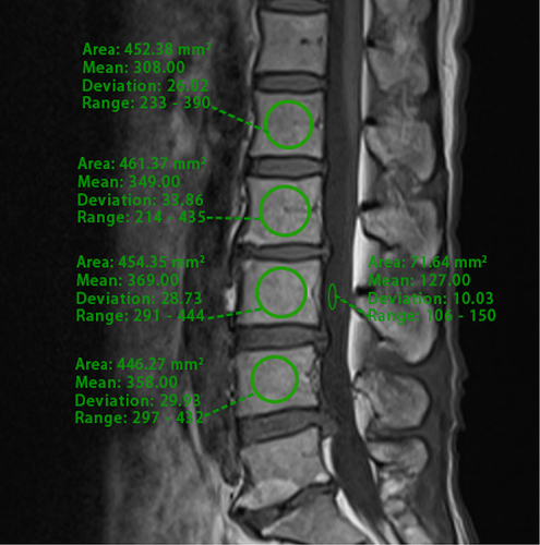 Figure 4 Sagittal non-contrast-enhanced T1-weighted MRI of the lumbar spine was conducted with ROI positioned at the vertebral bodies of L1-L4 and at the CSF level at L3 using the PACS.