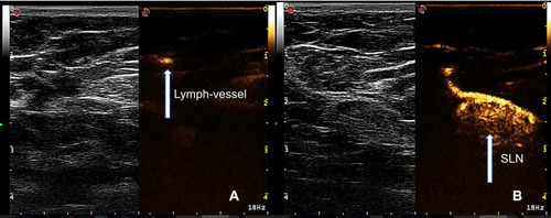 Figure 2 The lymph node enhancing process after the SonoVue injection. (A) A single lymph vessel was enhanced (arrow), then the enhanced vessel was traced to SLN. (B) The enhanced SLN (arrow), gray-scale ultrasound showed the same lymph node (arrow).