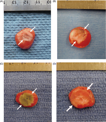 Figure 1. Gross pathologic specimens of RF-induced coagulation. Tumours treated with (A) RF alone, (B) liposomal quercetin 24 h pre-RF, (C) liposomal doxorubicin 15 min post-RF, and (D) triple therapy consisting of liposomal quercetin 24 h pre-RF and followed doxorubicin 15 min post-RF are presented. The central white area represents treatment-induced tumour necrosis/coagulation (as noted by the white arrows in each image), with viable tumour staining red. Greater coagulation was observed with RF-quercetin (13.1 ± 0.7 mm) and RF-doxorubicin (13.2 ± 1.3 mm) compared to RF alone (p < 0.001 for both comparisons). The amount of tumour coagulation further increased for triple therapy (quercetin-RF-doxorubicin) (14.5 ± 1.0 mm), compared with quercetin-RF (p = 0.016).