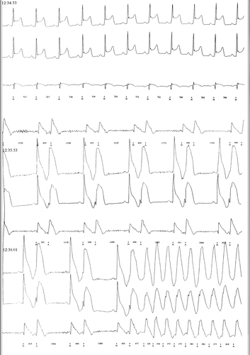 Figure 2. Three-channel Holter recording during syncope showing transient ST-segment elevation and ventricular extra-systoles, bigeminy and ventricular flutter at the time of maximal ST elevation.