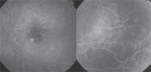 Figure 2 Late phase fluorescein angiogram OS showing multiple disseminated lesions of the posterior pole, mild cystoid macular edema, and serous retinal detachment.