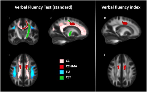 Figure 2 Significant relationships between patients’ verbal fluency test and verbal fluency index performances with their white matter tract integrity. Abbreviations: CC: corpus callosum; CC-SMA: callosal fibers linking the supplementary motor area; CST: corticospinal tract; L: left; R: right; SLF: superior longitudinal fasciculus.