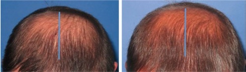 Figure 11 Baseline (left) versus 24-week (right) global photograph of treated vertex. Area on the left of midline treated with saline and area to the right of midline treated with fat + stromal vascular fraction.