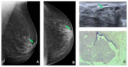 Figure 5 Left mammogram SDD (green arrow) at cranio-caudal (CC) (A) and medio-lateral oblique (MLO) (B) mammogram view. Targeted US shows intraductal heterogeneous intraductal content (green arrow) (C); H&E staining (x10) shows fibrocystic changes (D).