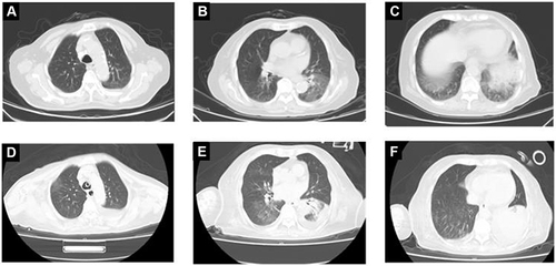 Figure 3 Chest CT of case 2 showed patches in the lower lobe of the left lung at admission (A–C). Three days later chest CT showed large consolidation of the left lung (G–F).