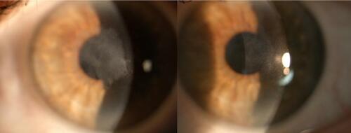 Figure 5 The figure shows slit lamp examination of a female patient 54 yrs old who had developed an evident haze 2 months after PRK. At that time her DCVA was 20/30 with −0.50sph=−3.50cyl (130°). After 8 months she underwent scraping of the stromal surface and application of mytomicin C. The images show left eye slit lamp photographs before (left) and 6 months after (right) the treatment. The corneal opacity is remarkably reduced, and her DCVA is now 20/25 with −0.50sph=−0.50cyl (150°).