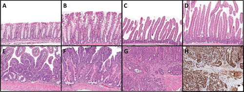 Figure 1. Morphological changes following intestinal Braf mutation. (A) Braf wild type colon and (B) Braf mutant colon 10 days after induction of the mutation. (C) Braf wild type small intestine and (D) Braf mutant small intestine 10 days after induction of the mutation. (E) A murine serrated precursor at 5 months. (F) A murine serrated adenoma with an overtly dysplastic zone at 14 months. (G) A moderately differentiated invasive cancer arising from a murine serrated adenoma at 14 months post-induction and (H) the same cancer showing retention of MLH1 protein.