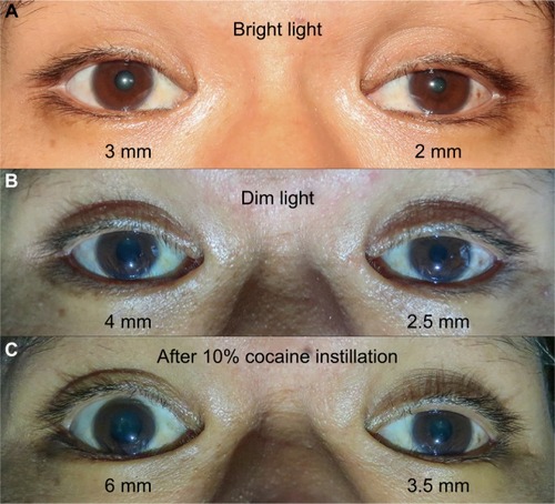 Figure 2 Pupillary examination shows anisocoria.