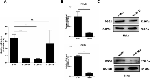 Figure 2 Knockdown of DSG2 in cervical cancer cells. (A) The knockdown efficiency of the three groups of siRNA in HeLa cells was 84%, 86% and 28%, respectively. (B and C) The specificity and validity of the siRNA knockdown of DSG2 expression in HeLa and SiHa cells was verified by qPCR (B) and WB (C). *P < 0.05, **P < 0.01.