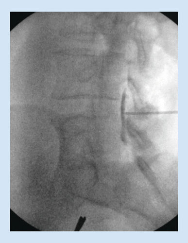 Figure 3. Preoperative epidurogram establishes a baseline for evaluating the epidural space and creating a safe visual field to direct the operative devices.