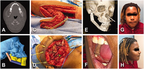 Figure 3. (A) A 14-year-old male with 5.3 × 4 cm2 multicystic ameloblastoma of the right posterior body and ramus of the mandible. Patient asymptomatic until tumor was detected in a routine dental appointment. History of chronic sinusitis treated with anti-allergic agents. No tobacco or alcohol consumption. BMI of 22 kg/m2. (B) Virtual surgical planning was performed prior to the surgery. (C, D) Ameloblastoma was treated with tracheostomy, right hemimandibulectomy, right submandibular gland resection, right fibula free flap (two segments) with reconstruction plate and right IAN grafting (green arrowhead). (e) Prior to discharge, CT scan facial bones with 3D reconstruction was performed to check the FFF construct. Length of stay of 12 days. (F–H) No postoperative complications except hypertrophic scars of submandibular and tracheostomy incisions.