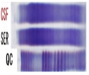 Figure 5 Cerebrospinal Fluid Electrophoresis Results.