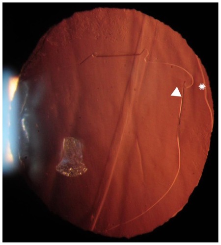 Figure 1B Photograph with transillumination showing the double-ring sign.