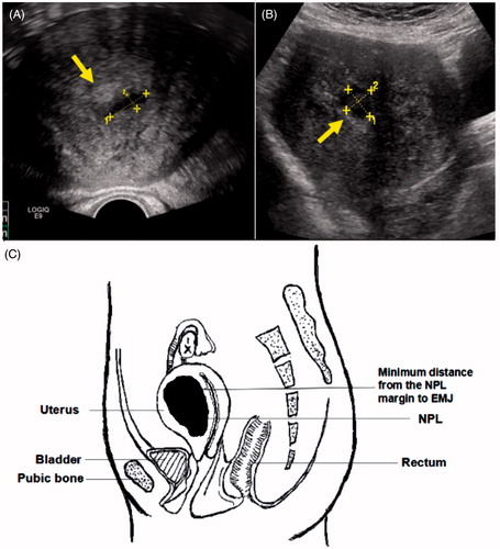 Figure 2. (A, B) The zone of liquidation necrosis as observed via ultrasonography; yellow arrows identify the endometrium. The liquidation necrotic zones were connected to the endometrium. (C) Schematic diagram post-ablation. EMJ, endomyometrial junction; NPV, non-perfused lesion volume; NPL, non-perfused lesion.