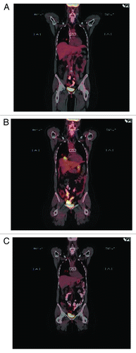 Figure 7. Baseline PET scan shows two small lesions in the lower lobe of the right lung (A). The lesions FDG uptake on PET scan that was done 7 wk into the beginning of vaccination (B). PET scan six months later (C) showed return to baseline with no new lesions elsewhere.