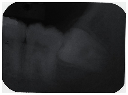 Figure 2 Left mandibular third molar of an 18-year-old man without acute pericoronitis.