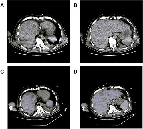 Figure 2 Abdominal CT images of the patient. Abdominal CT image results showed multiple hypodense foci in the liver and a small amount of fluid in the abdominal cavity. (A and B) Abdominal CT on August 19, 2022. (C and D) Abdominal CT on August 21, 2022.