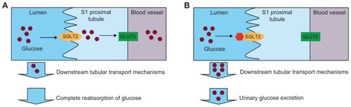 Figure 1 (A) In the normal range of blood glucose levels, the majority of glucose is reabsorbed in the kidney predominantly via the action of SGLT2 and GLUT2 in the S1 segment of the proximal tubule. (B) SGLT2 inhibitors block the reabsorption of glucose in the S1 proximal tubule under normal or hyperglycemic conditions, resulting in urinary glucose excretion.