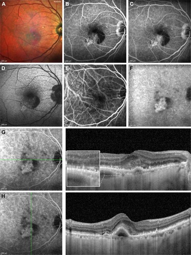 Figure 3 Multicolor imaging, FA, fundus autofluorescence, ICGA and structural SD-OCT of a patient affected by RPD and a type 1 CNV.