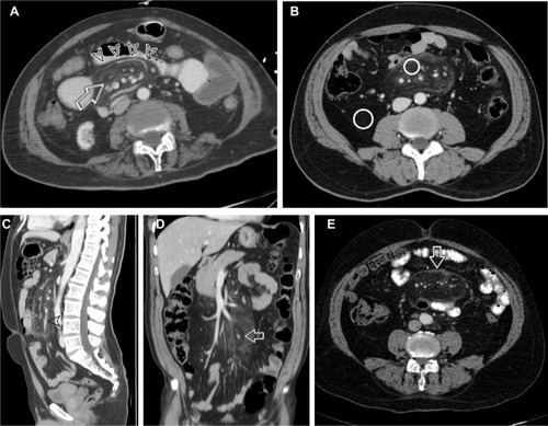 Figure 1 Abdominal computed tomography scans showing the classical signs of mesentric panniculitis.