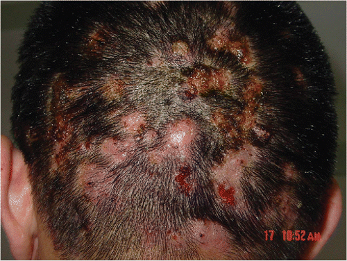 Figure 3. Perifolliculitis capitis abscedens et suffodiens.