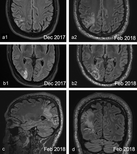 Figure 1. FLAIR MRI images of DN’s brain. (a1-b2) Comparisons of axial scans between December 2017, before the onset of the micropsia (a1 and b1) and February 2018, after the onset of the micropsia (a2 and b2). An increased size of the infarction throughout the occipital and parietal lobe can be seen. (c) Sagittal view. (d) Coronal view.