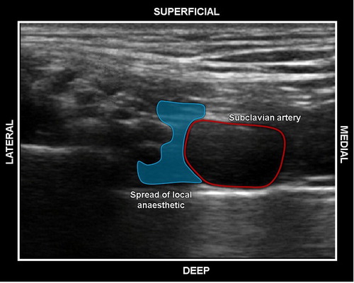Figure 10: Spread of local anaesthetic solution (hypoechoic area high around the SCA) around the BP, concealing it from view on the ultrasound machine.