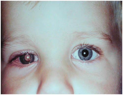 Figure 10: Leucocoria and a persistent red eye