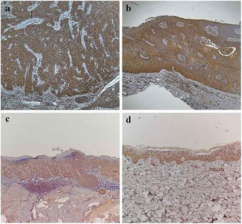 Figure 1. Expressions of mTOR in CSCC, BD, AK, and normal skin. (a) Positive expression of mTOR in CSCC (SP, ×200), Positive(+++). (b) Positive expression of mTOR in BD (SP, ×200), Positive(++). (c) Positive expression of mTOR in AK (SP, ×200), Positive(++). (d) Positive expression of mTOR in normal skin (SP, ×200), Positive(++)