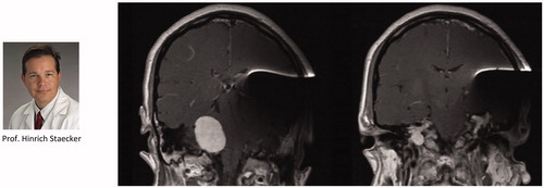 Figure 20. MRI with MED-EL’s SYNCHRONY ABI implant demonstrated clear and quality images of the contralateral side. The ABI created moderate metallic artefact distortion that limits evaluation of the ipsilateral cerebral and cerebellar hemispheres. Image adapted from Shew et al. [Citation16].