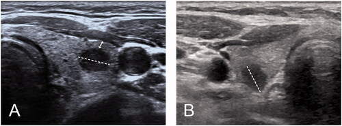 Figure 1. (A) Measurement of distance between PTC tumor to thyroid capsule 348 (double headed arrow); (B) PTC tumor abutted to thyroid capsule without CI.