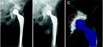 Figure 1. A: Example of an anterior–posterior (AP) hip radiograph with preoperative osteolytic bone deterioration with excessive cup protrusion and loosening. B: Postoperative AP radiograph with reconstruction of the contained acetabular bony defect using the bone impaction grafting technique without metal meshes. C: With dual-energy X-ray absorptiometry, bone mineral density was measured in 3 separate regions of interest covering the postoperative acetabular impacted bone graft: cranial (green), medial (red), and caudal (blue) to the polyethylene cup. The same ROI template was used for each subsequent time interval.