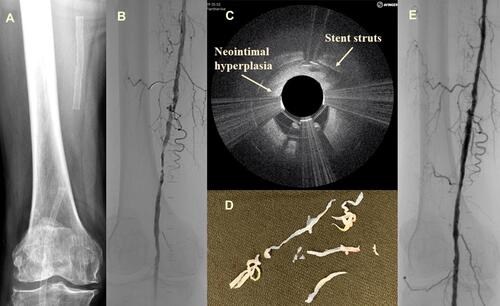 Figure 1 (A) Preoperative radiography showing the stent position; (B) intraoperative angiography; (C) during OCT-guided atherectomy; (D) neointimal hyperplasia/plaque material was removed; (E) angiography after completion.