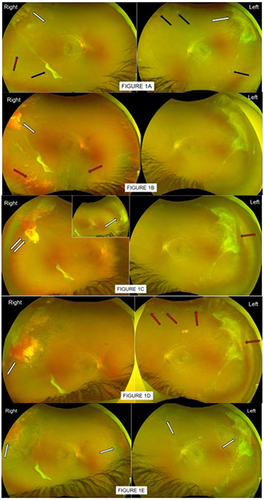 Figure 1 (A) Patient 1, first seen by optician at aged 13 who queried temporal retina lesions and hazy view in both eyes. First clinic attendance in 2022 August, confirmed good vision of 6/6 each eye but history of Right eye frequent floaters. Visible in these photos are large auto-infarcted seafan fibrotic scars on traction in peripheral supero-temporal retinae (white arrows) in both eyes; other smaller pre-retina fibrosis (black arrows), ghost vessels (red arrow), flat retina and no evidence of vitreous hemorrhage in either eye. No treatment was offered. (B) By 2023 June, patient 1 re-presented in eye casualty with Right eye vitreous hemorrhage (red arrows) with flat retina and reduced vision of 6/60. Previous supero-temporal large seafan fibrotic scar was also enveloped with hemorrhage (white arrow). Left eye status unchanged, good vision 6/6. Patient was referred to specialist sickle eye clinic for further management. (C) By 2023 September, Right eye vision improved to 6/7 as vitreous hemorrhage gravitated, revealing more auto-infarcted seafan scar on traction in supero-nasal peripheral retina (white arrow), previous blood-enveloped seafan site had part altered blood still masking any underlying reactivation of seafan (double white arrows). Left eye good vision, no vitreous hemorrhage but small “reactivated tips” were noted in previous auto-infarcted seafan scar (red arrow). With the clearing view, patient 1 was advised and received same day localized barrier laser to Right eye, to prevent retinal detachment with future traction bleed. Left eye was to be observed. (D) By 2023 December, Patient 1 maintained good vision 6/9 Right, 6/7 Left. Assessment showed no fresh/added vitreous hemorrhage in Right eye, previous barrier laser appeared inadequate (white arrow). Left eye however had worsened features of reactivation of some seafans on traction (red arrows), with evidence of gravitated vitreous hemorrhage (new). Patient was advised and received further laser top-up to Right eye, barrier laser to left eye. (E) By 2024 April, patient 1 reported no episodes of new floaters, vision remained good and unchanged. Assessment confirmed no clinical evidence of new added vitreous hemorrhage in either eye, previously treated seafans and traction scars (white arrows) were less aggressive and altered blood resolved. Left eye had a new sprouting seafan (not in photo view). Patient received additional sector laser to Left eye new seafan; scheduled for routine review in 6 months, earlier if experienced episode of unsettling floaters.