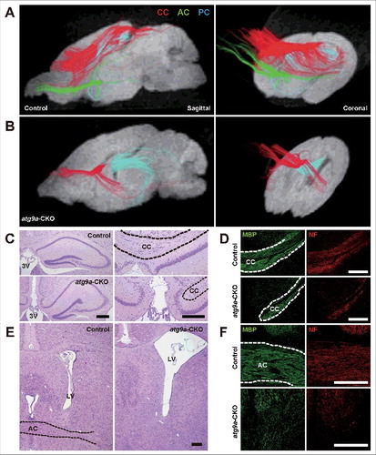 Figure 4. Dysgenesis of the corpus callosum and anterior commissures. (A, B) Diffusion tensor tractography of the corpus callosum (CC; red), anterior commissures (AC; green) and posterior commissures (PC; blue) in floxed control (A) and atg9a-CKO (B) mouse brains at P21. Sagittal direction (left) and coronal direction (right). (C to F) Intact and dysgenetic figures of the corpus callosum (C, D) and anterior commissures (E, F) from floxed control and atg9a-CKO mice at P28. HE staining (C, E) and immunofluorescent staining of myelin basic protein and phosphorylated neurofilaments (NF) (D, F). Black and white broken lines indicate the respective nerve fibers. LV, lateral ventricle; 3V, third ventricle. Scale bar: 200 μm.